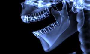 Cas clinique : Les implants dentaires